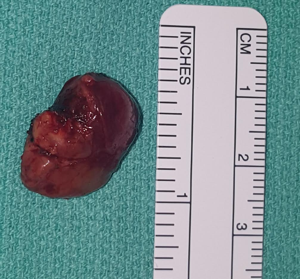 Parathyroidectomy